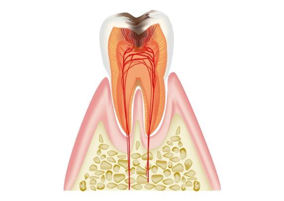 歯髄う蝕