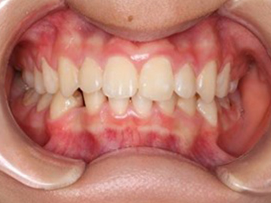 （小児）出っ歯の矯正の治療