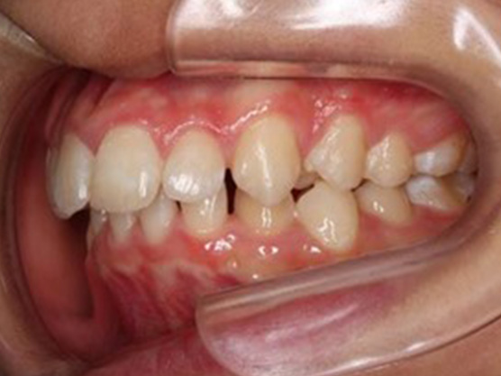 （小児）出っ歯の矯正の治療