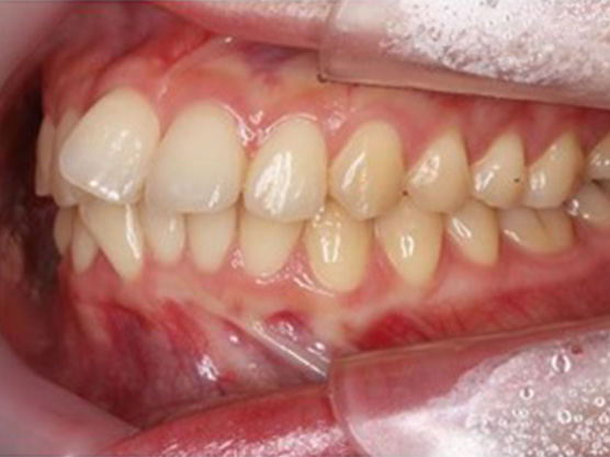 出っ歯の治療例