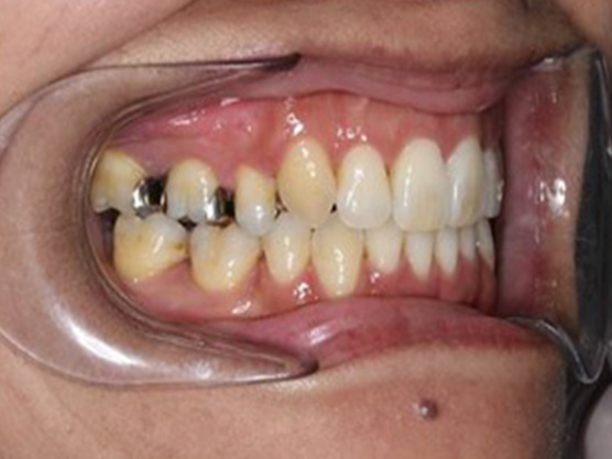 八重歯の治療例