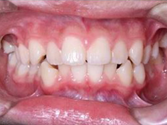 （小児）出っ歯の治療例