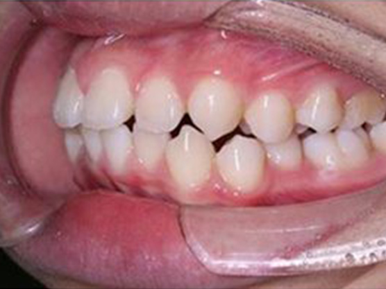 （小児）出っ歯の治療例