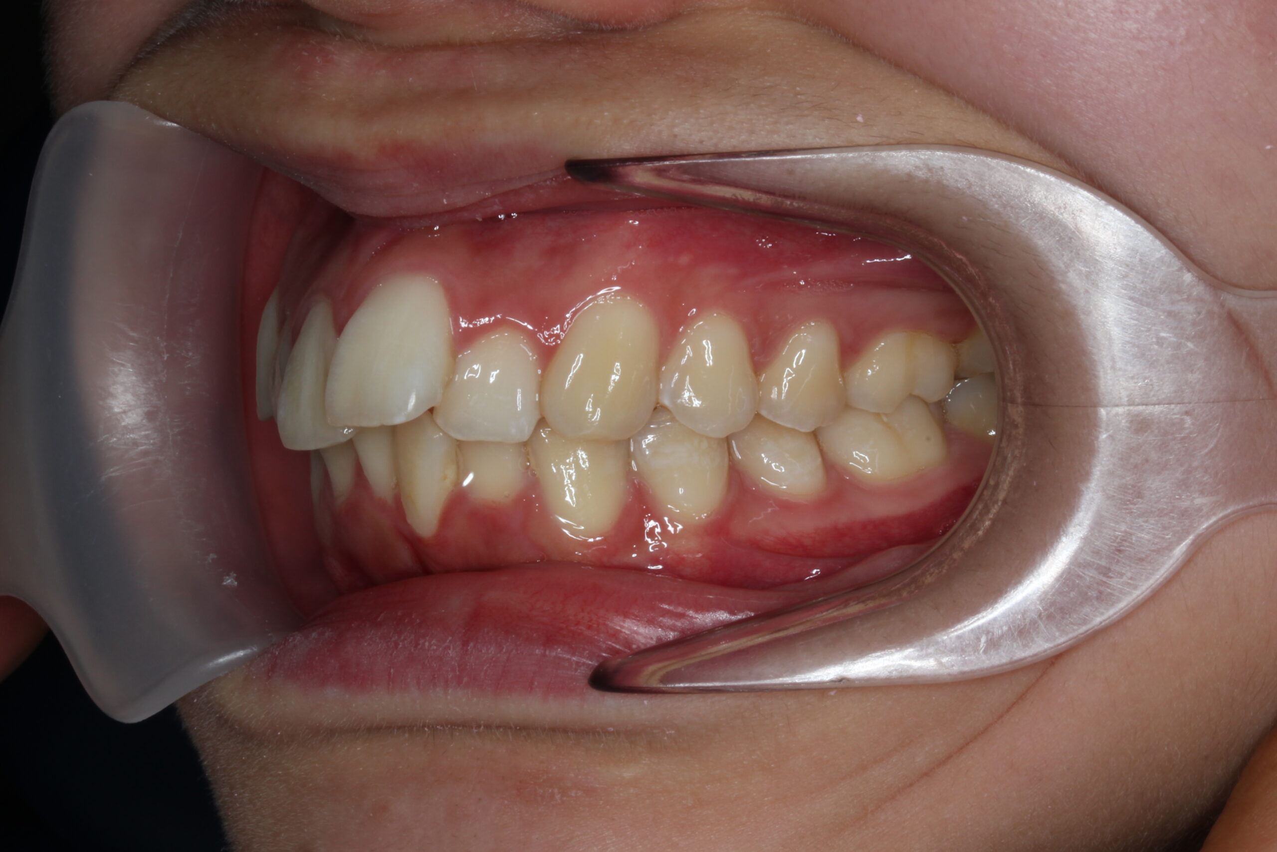 出っ歯の矯正治療